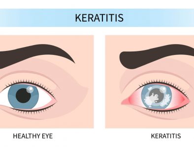 neurotrophic_keratitis_hero neurotrophic_keratitis_hero