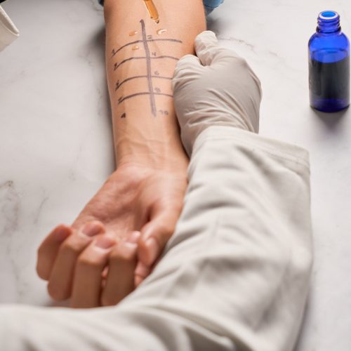 Skin,Prick,Allergy,To,Find,Out,Kind,Of,Allergy